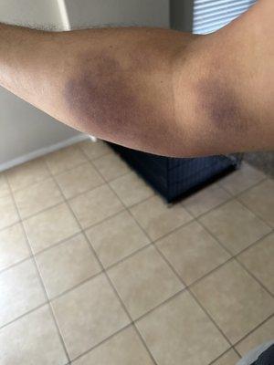 Pain bruising in arm a week after. Called with no answer left a message with name and number and still have not received a call.