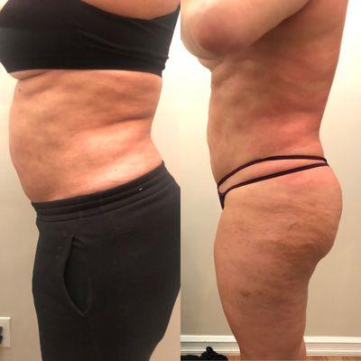 break down scar tissue after liposuction