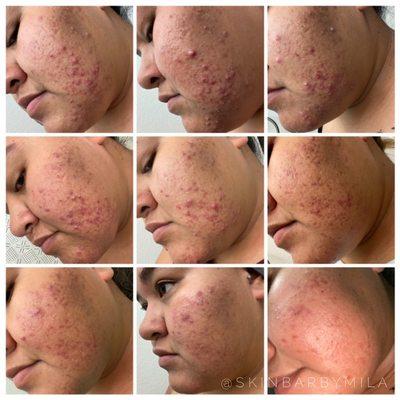 Not all acne clients are the same. It takes time and dedication and we will get there!