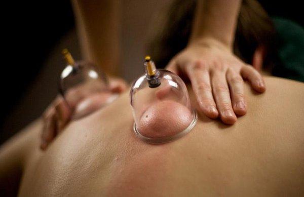 Cupping Therapy