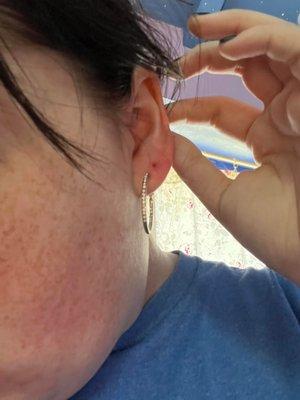 Possible ear infection from ear piercing (see second hole only, standard piercing)