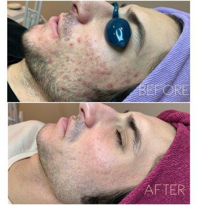 Acne Clinic results