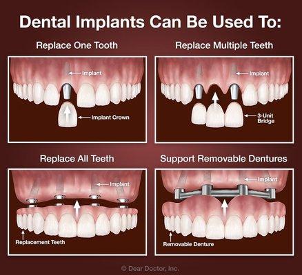 Missing One or More Teeth?