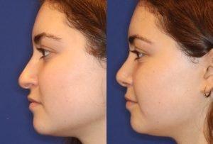 Rhinoplasty