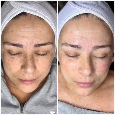 Anti-Aging Facial