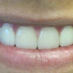 Porcelain Veneers