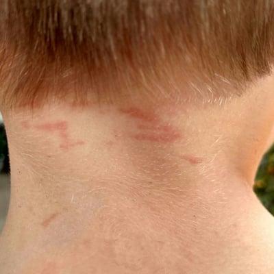 My son's neck after the visit, and minimally better at bedtime, 9 hours later.