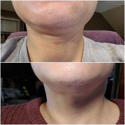 Under chin skin tightening before/after 3 week progression.