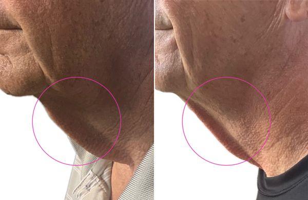 Cryo Neck & Chin Tighten - before-and-after