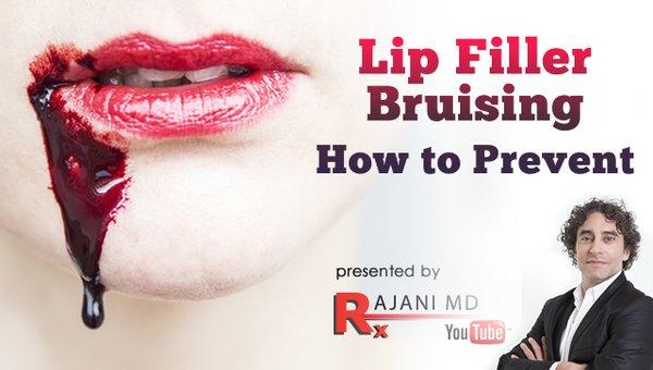 https://www.youtube.com/watch?v=cXarHt2UMTc
 
 How to prevent bruising when getting lip filler. Get fuller lips without bruising!