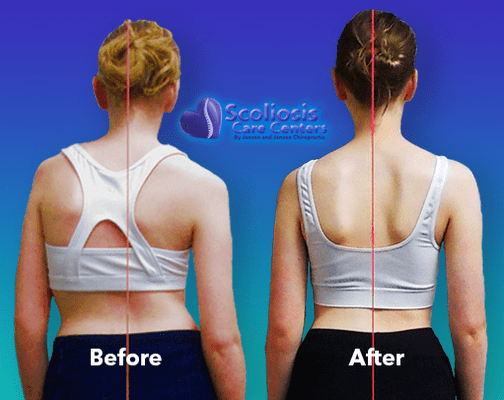 Non-surgical scoliosis treatment to not only prevent surgery, but help straighten the spine!