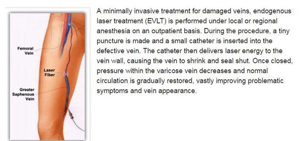 Endovenous Laser Treatment