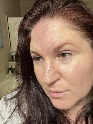 20 units Botox + 1 cc Juvederm on Thur, Jan 19. Skin is dry, peeling & bruised on forehead, nose & inner eyelid. Photos from 1/19 & 1/22.