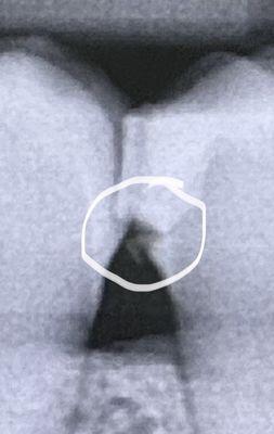 Up close of the x ray done at shoreline showing the problem area they left me with