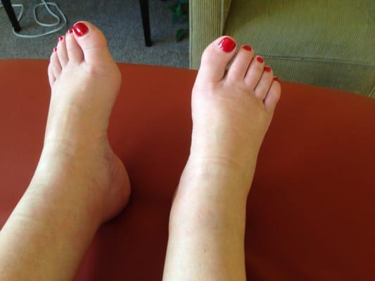 Swelling in the feet and ankles before treatment