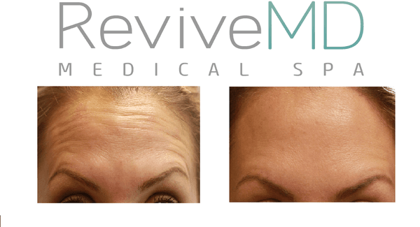 10 Units Botox Cosmetic - Applied to the Forehead.  Client desired very little movement.