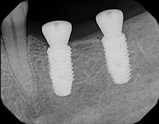 Patients X-Ray reports for Dental Implants