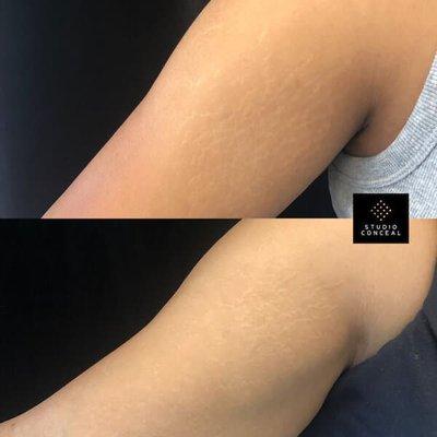 before and after of stretch mark camouflaging with one session of inkless ink