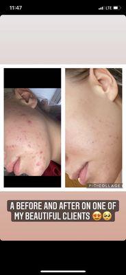 Before & after acne facials & pharmaceutical grade skincare on my client!