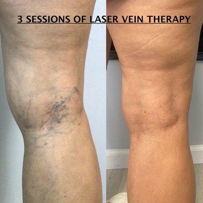 LASER THERAPY FOR VEINS-  3 SESSIONS PERFORMED 8-12 WEEKS APART