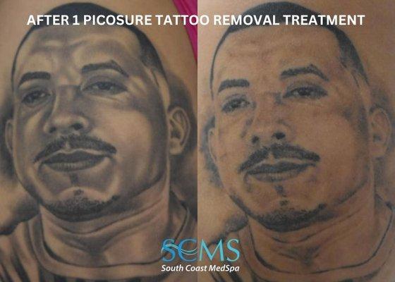 Laser Tattoo Removal Before and After showing amazing removal of shading on tattoo after just 1 treatment