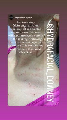 Skin tag removal