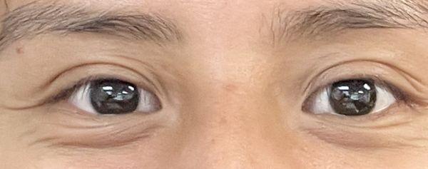 Before treatment, eyelashes