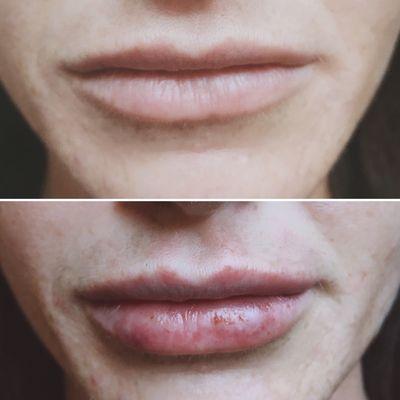 Lip filler by crystal