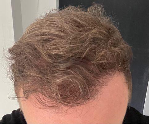 After 6 hair PRP treatments post-transplant