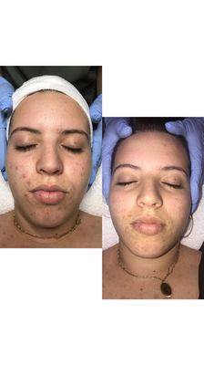 Resultados de tratamiento Dermapen  para el acné