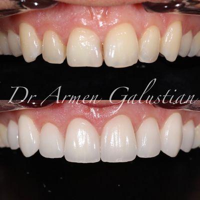 Smile makeover with porcelain veneers and gum reshaping