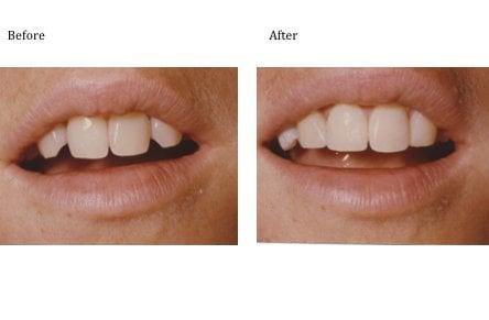 Reshaping and composite recontouring of lateral incisors