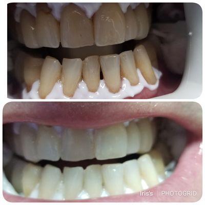 Zoom Whitening