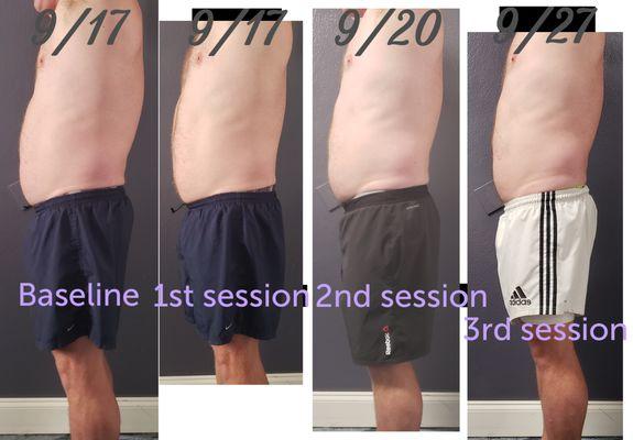 Cavitation (fat reduction) - male client 3 sessions