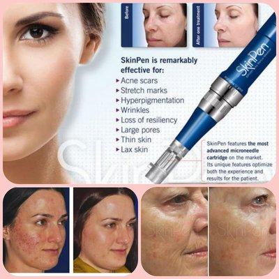 Offering Microneedling!