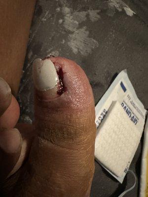 Infected cuticle