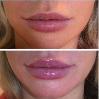 Lips Before and After