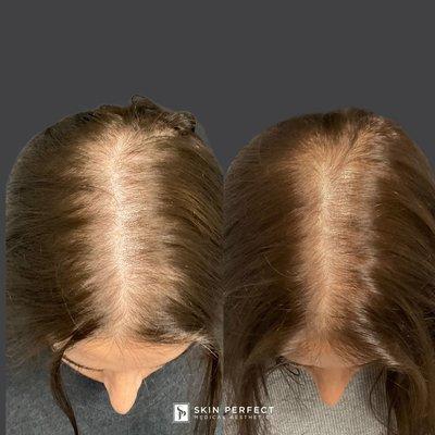 PRP Hair Growth Injections