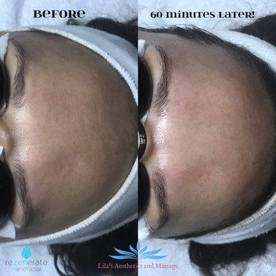 60 minute facial with Rezenerate