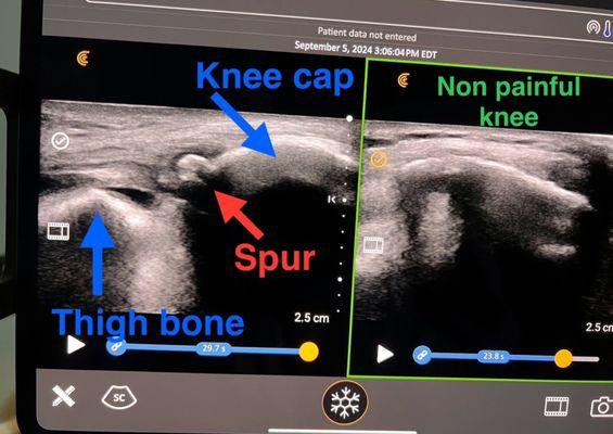 Musculoskeletal ultrasound image taken during our initial evaluation of a person with knee cap pain. (Taken with permission)