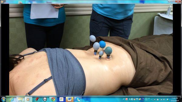 Magnetic cupping