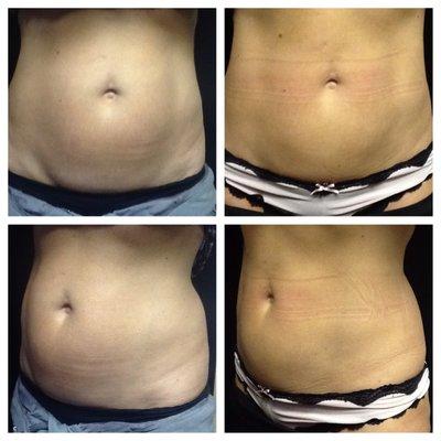 CoolSculpting Before and After photos. (8 weeks post treatment)