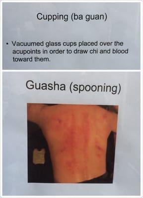 Cupping (ba guan)& Gua Sha (Spooning)