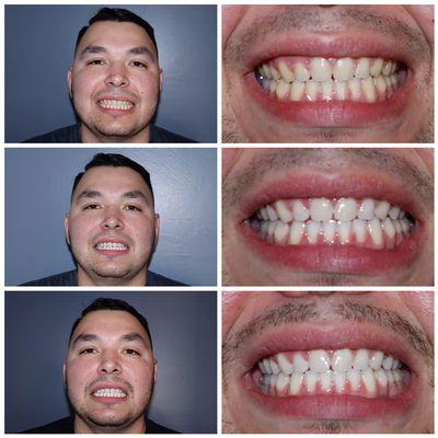 Whitening after braces.