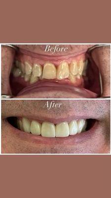 Another smile makeover by Dr. Aldujaili. Call the office for more information at 949-360-4241