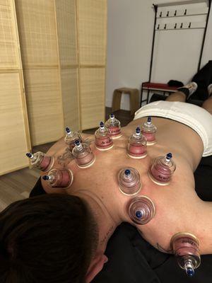 Cupping therapy focusing the shoulders, trapezius and thoracic paraspinal muscles.