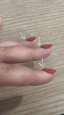 Thick uneven nail beds