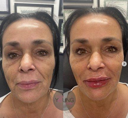 full face rejuvenation, Juvederm Voluma in cheeks, Revanesse Lips 1.2 ml in lips