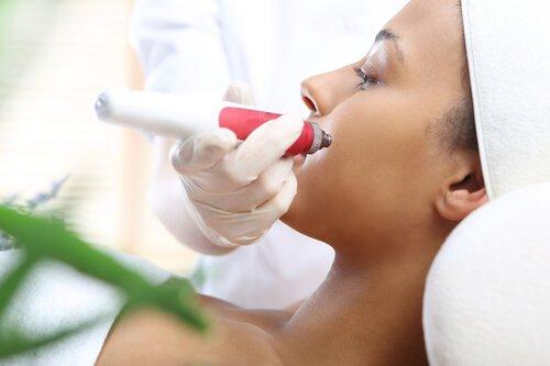 Microneedling