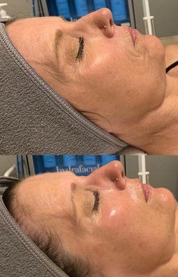 HydraFacial before and after look at the lines disappear! Smooth and glowing